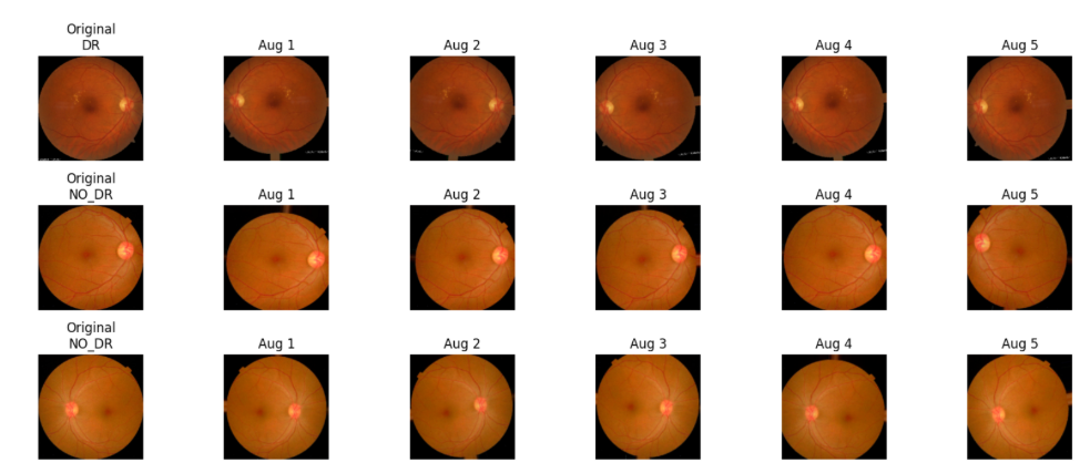 Ejemplos de imágenes de fondo de ojo originales y sus versiones aumentadas