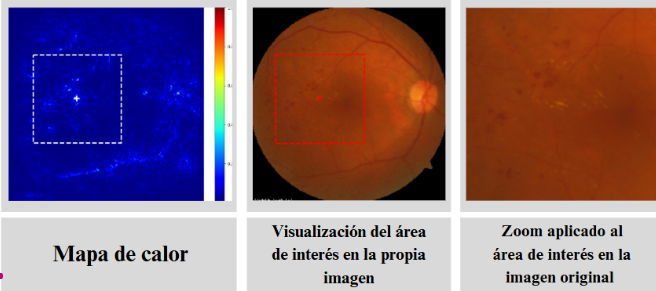 Mapa de calor Grad-CAM, área de interés sobre la imagen de fondo de ojo y zoom del área