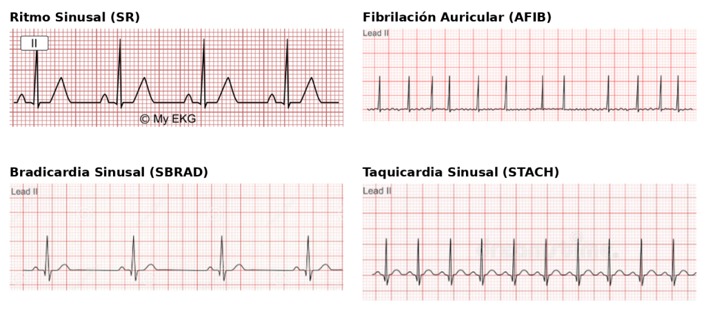 Trazos de ECG de ritmo sinusal, fibrilación auricular, bradicardia sinusal y taquicardia sinusal