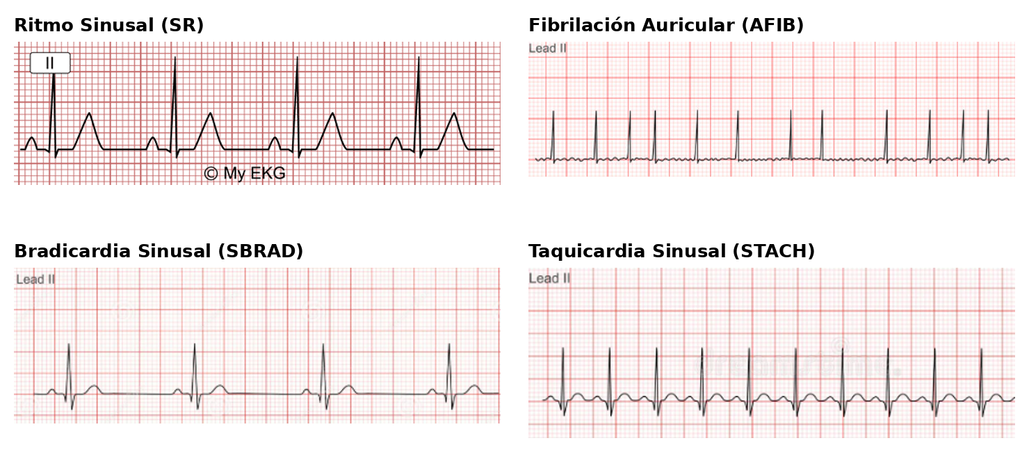 Trazos de ECG de ritmo sinusal, fibrilación auricular, bradicardia sinusal y taquicardia sinusal